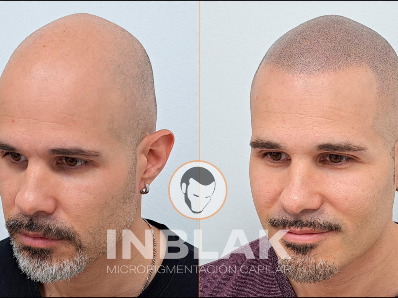 Resultados de micropigmentación capilar: antes y después